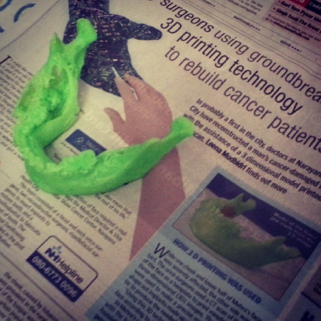 Thats the actual 3d printed jaw on the news paper. This was the one used by surgeon to help in modeling the face. Super cool. I got to meet the surgeon too. It was awesome to see how this 3d model helped.them.[City surgeons using ground breaking 3D printing technology to rebuild cancer patients face.]